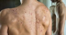 What is the cause of cystic acne?