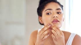 How to treat hormonal acne naturally
